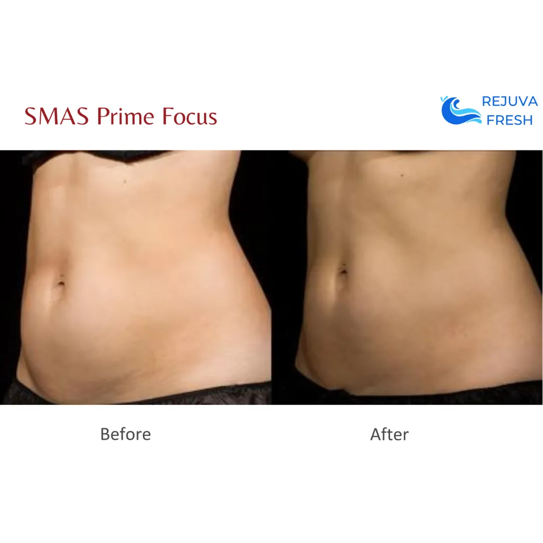 SMAS Prime Focus Professional HIFU Machine for Body & Face