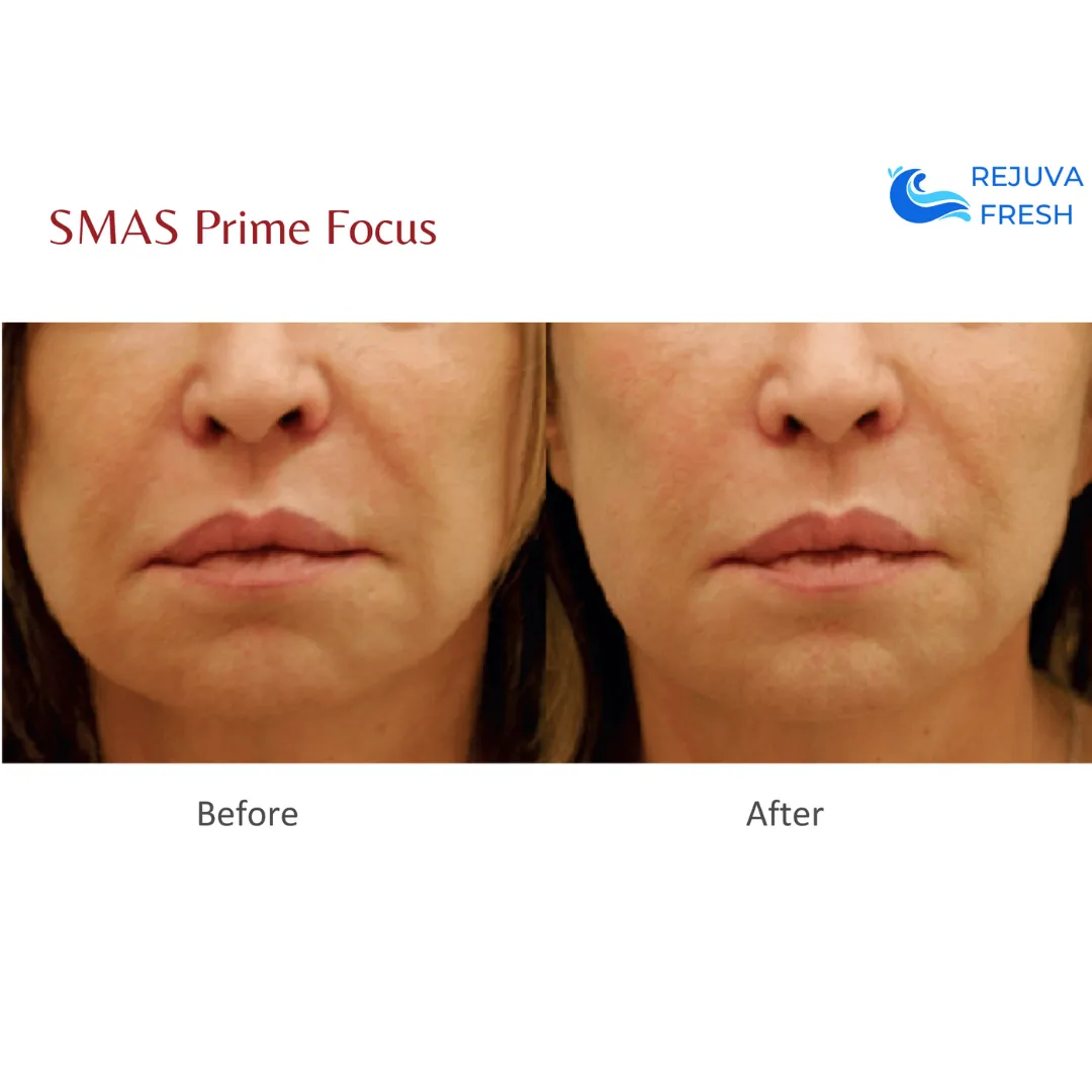 SMAS Prime Focus Professional HIFU Machine for Body & Face