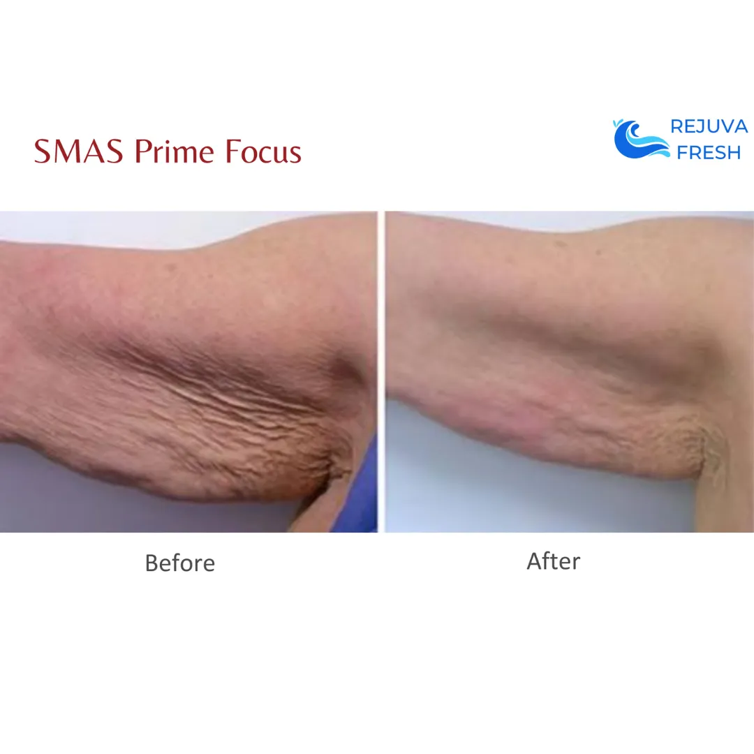 SMAS Prime Focus Professional HIFU Machine for Body & Face